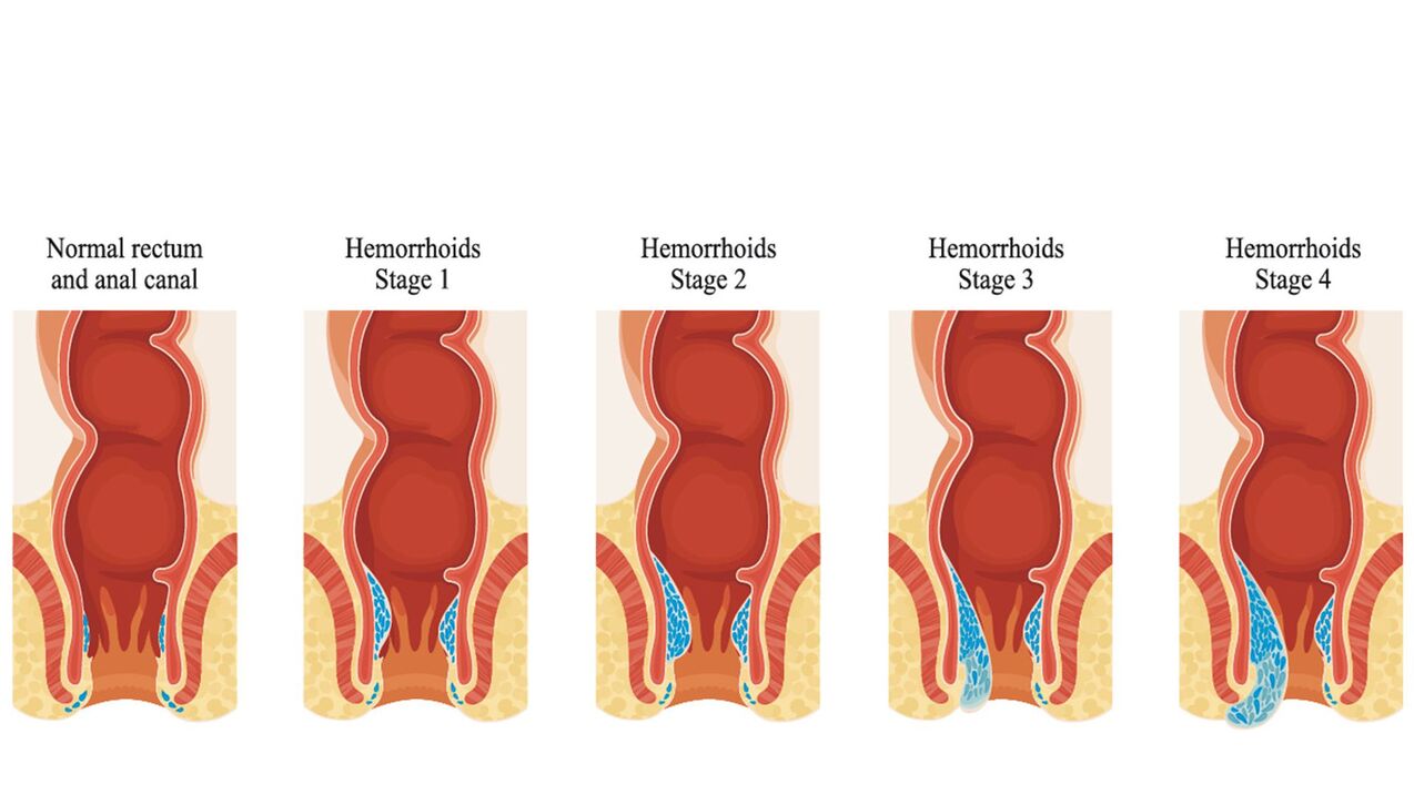 Tipos de hemorroides